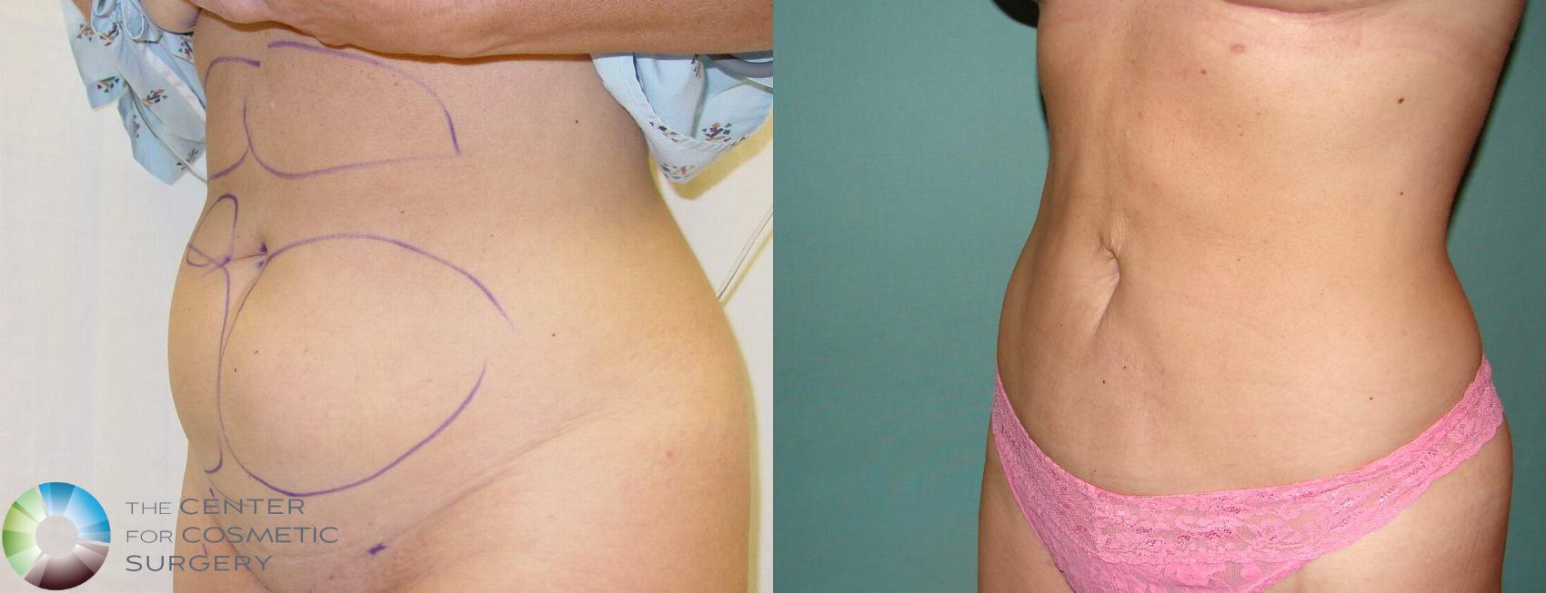 Before & After Liposuction Case 601 View #2 View in Denver & Golden, CO