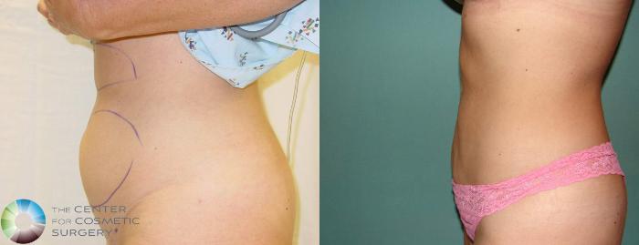 Before & After Liposuction Case 601 View #3 View in Golden, CO