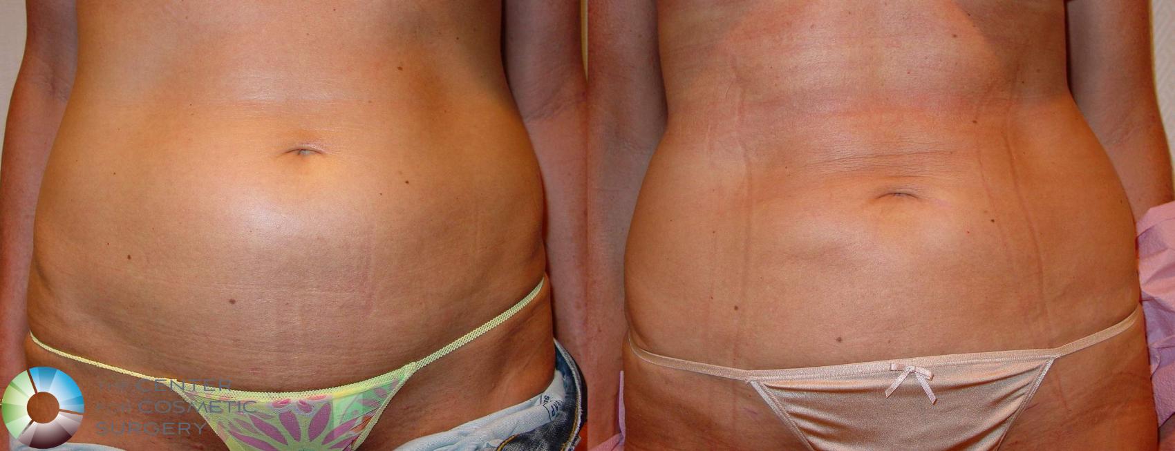 Before & After Liposuction Case 602 View #1 in Denver and Colorado Springs, CO