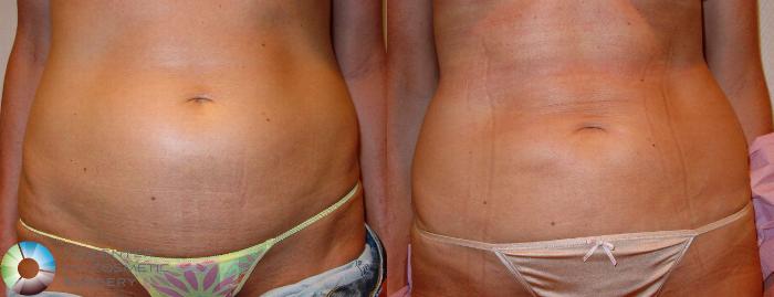 Before & After Liposuction Case 602 View #1 View in Golden, CO