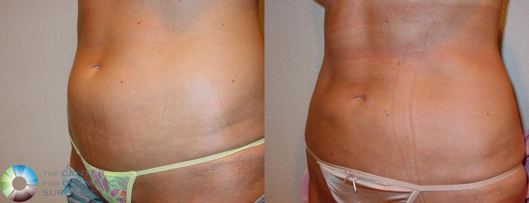 Before & After Liposuction Case 602 View #2 in Denver and Colorado Springs, CO