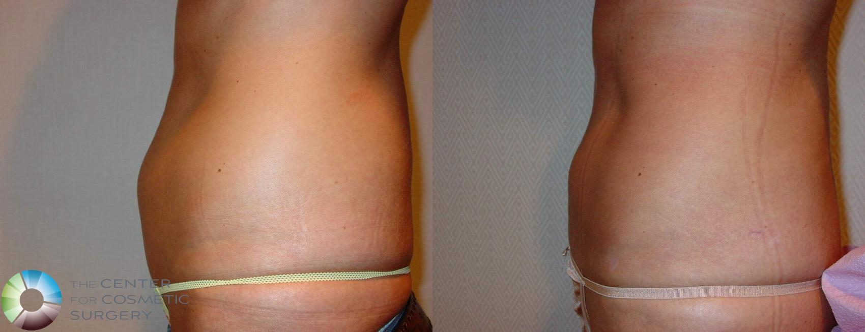Before & After Liposuction Case 602 View #3 in Denver and Colorado Springs, CO