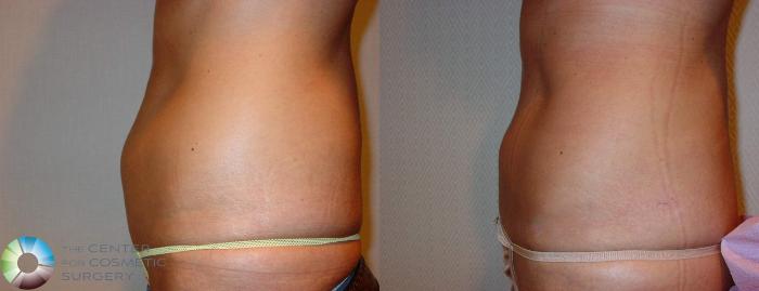 Before & After Liposuction Case 602 View #3 View in Golden, CO
