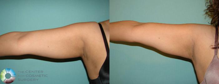 Before & After Arm Lift Case 603 View #1 in Denver and Colorado Springs, CO