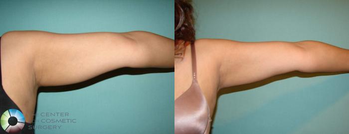 Before & After Liposuction Case 603 View #2 in Denver and Colorado Springs, CO