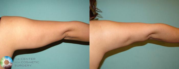 Before & After Liposuction Case 603 View #4 in Denver and Colorado Springs, CO