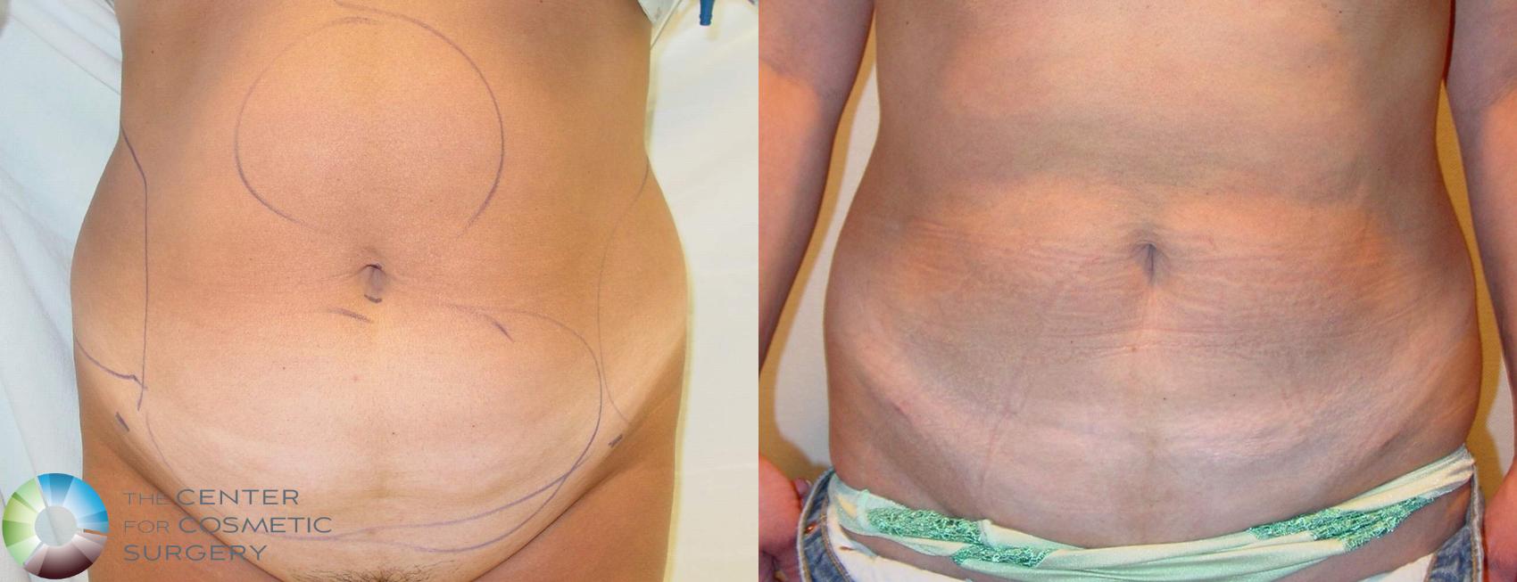 Before & After Liposuction Case 604 View #1 in Denver and Colorado Springs, CO