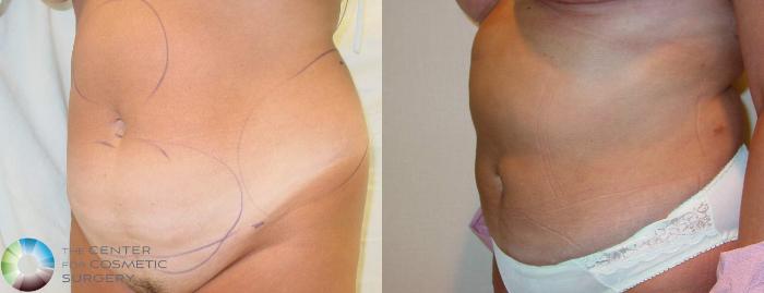 Before & After Liposuction Case 604 View #2 View in Golden, CO