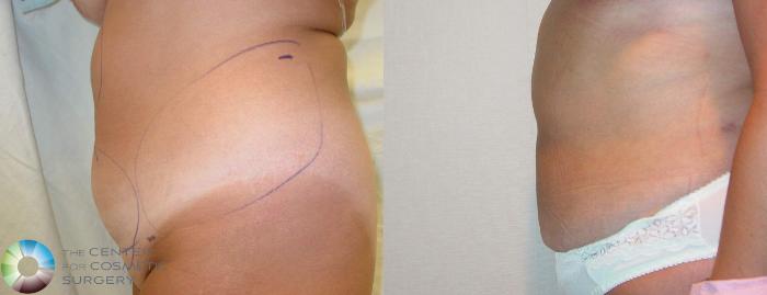 Before & After Liposuction Case 604 View #3 View in Golden, CO