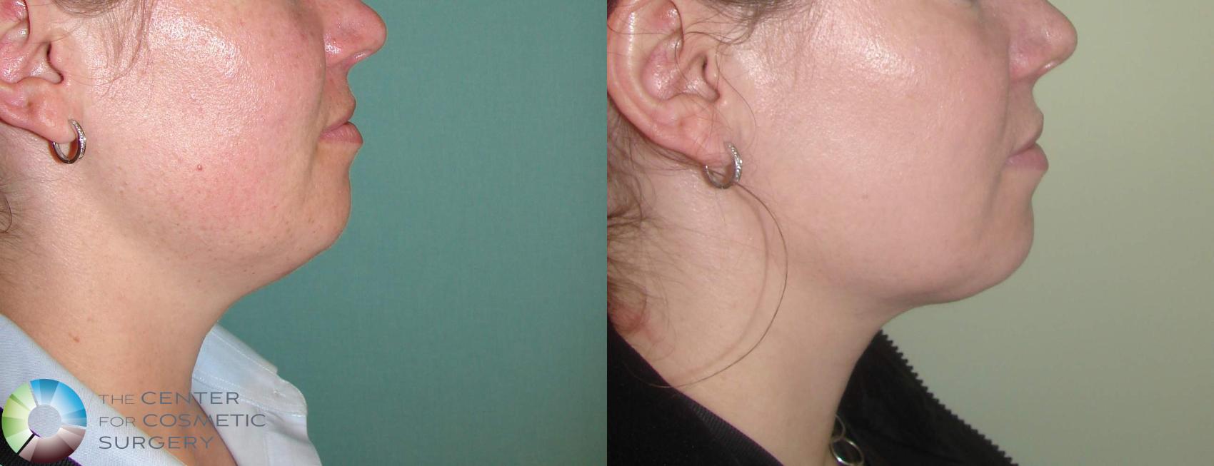 Before & After Neck Lift Case 605 View #1 in Denver and Colorado Springs, CO