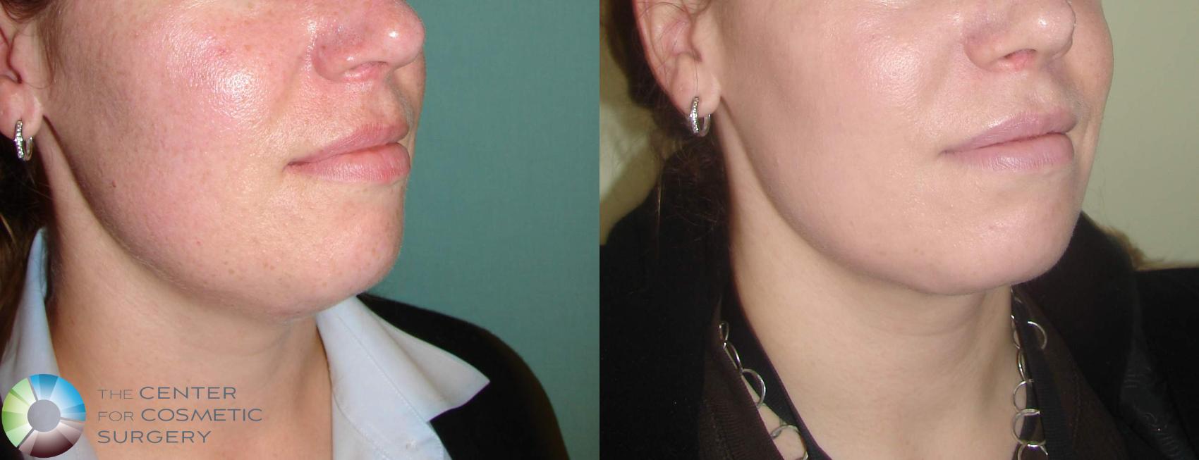 Before & After Liposuction Case 605 View #2 in Denver and Colorado Springs, CO
