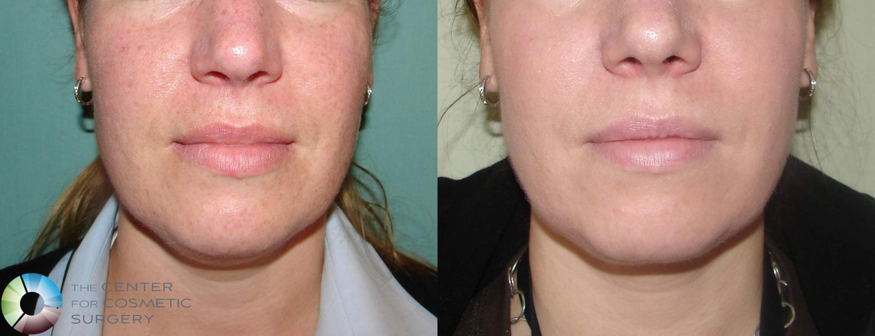 Before & After Liposuction Case 605 View #3 View in Denver & Golden, CO