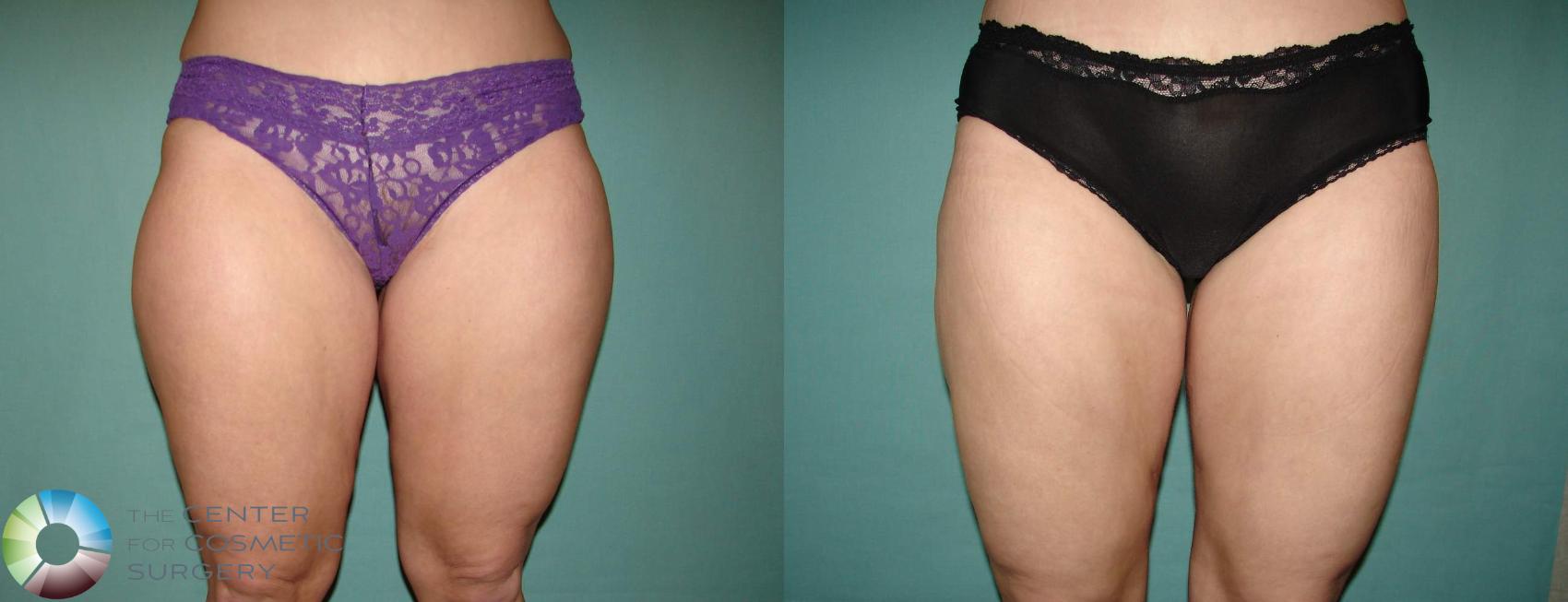 Before & After Liposuction Case 652 View #1 in Denver and Colorado Springs, CO