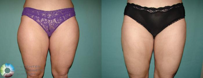 Before & After Liposuction Case 652 View #1 View in Golden, CO