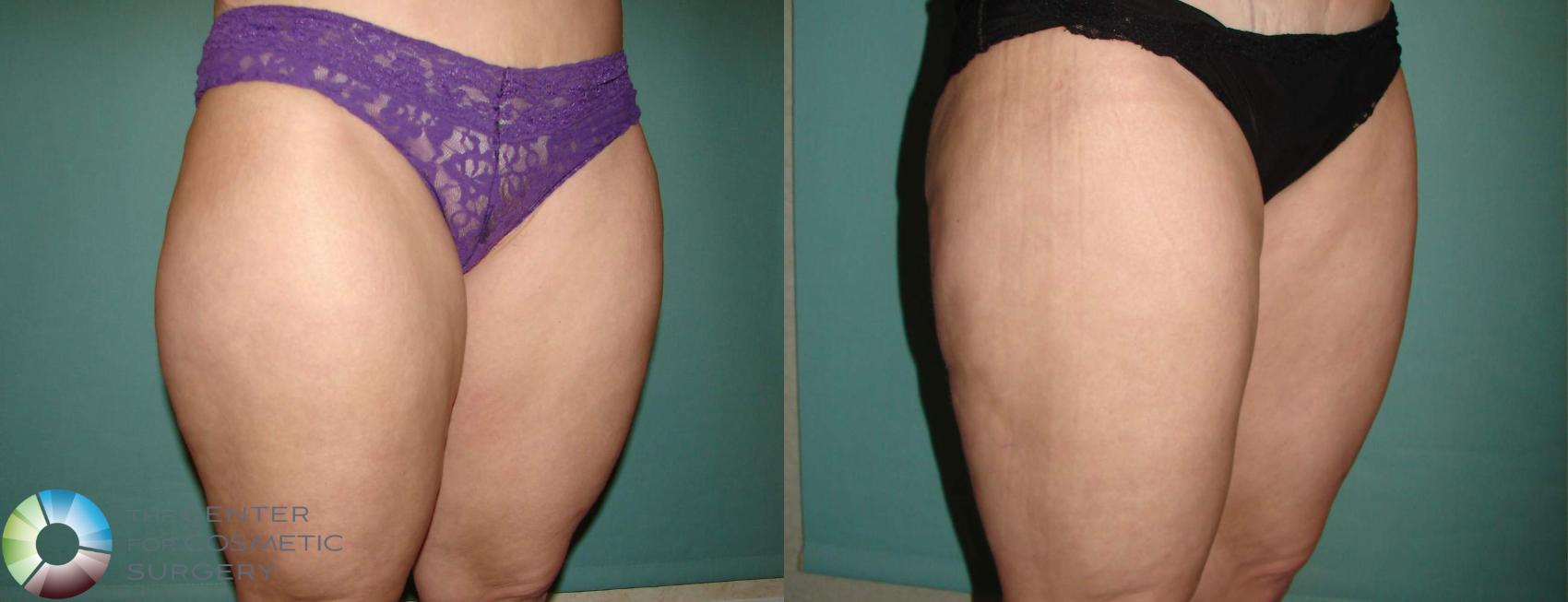 Before & After Liposuction Case 652 View #2 in Denver and Colorado Springs, CO