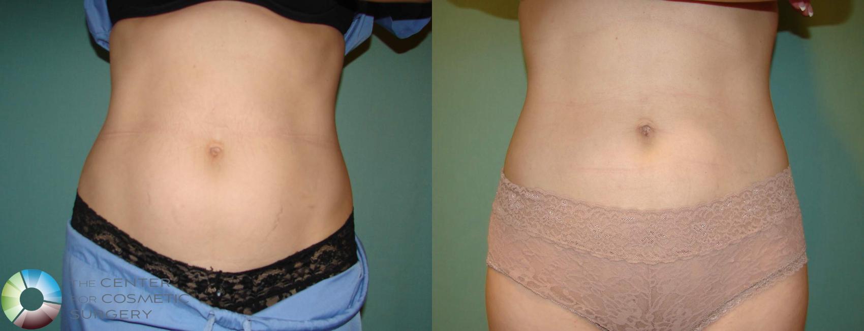 Before & After Liposuction Case 653 View #1 in Denver and Colorado Springs, CO