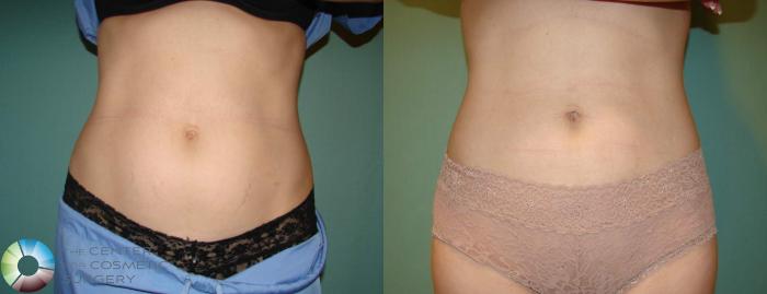 Before & After Liposuction Case 653 View #1 View in Golden, CO