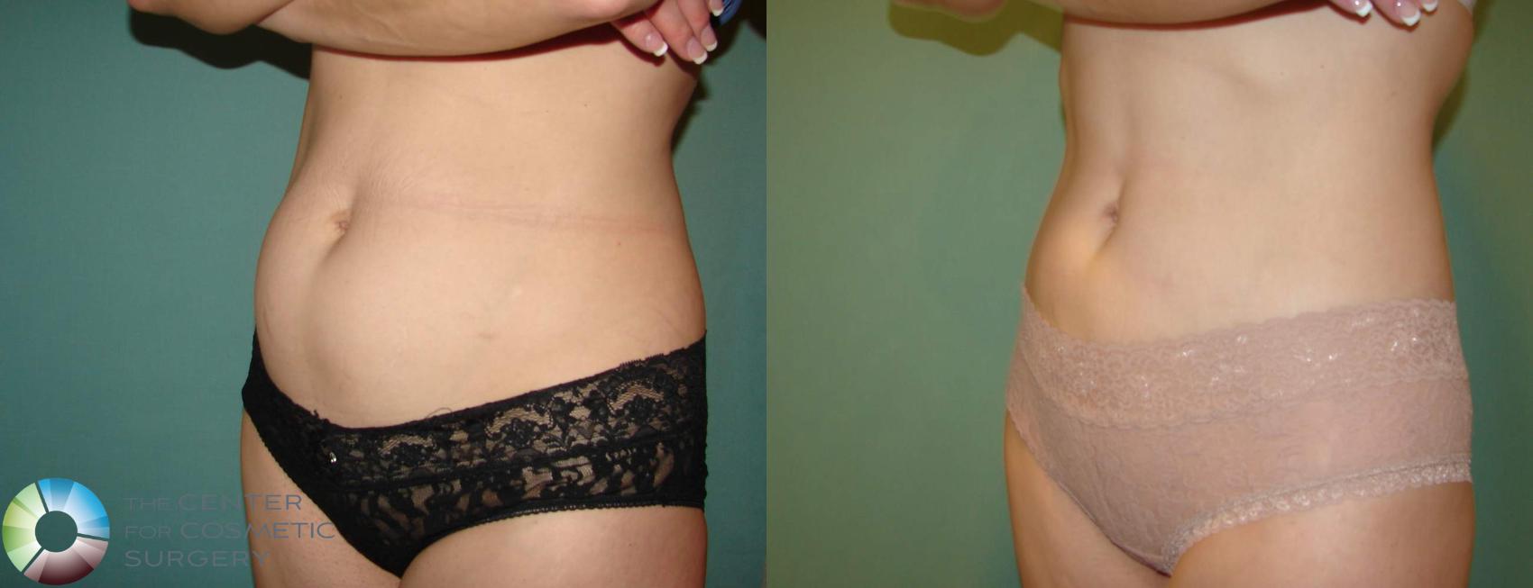 Before & After Liposuction Case 653 View #2 View in Golden, CO