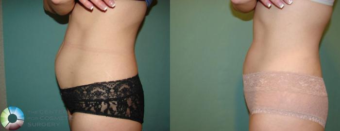 Before & After Liposuction Case 653 View #3 View in Golden, CO