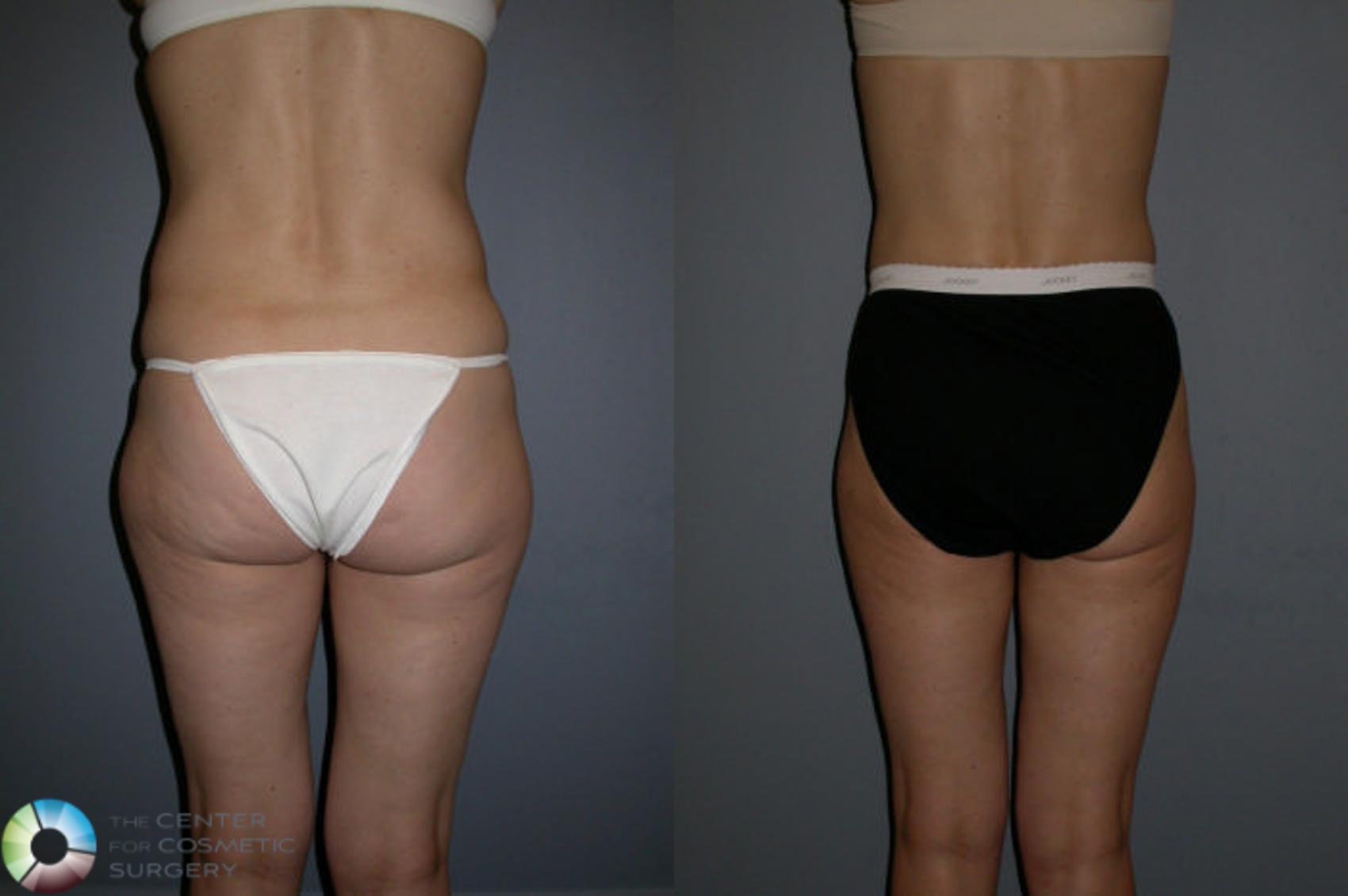 Before & After Liposuction Case 68 View #1 in Denver and Colorado Springs, CO