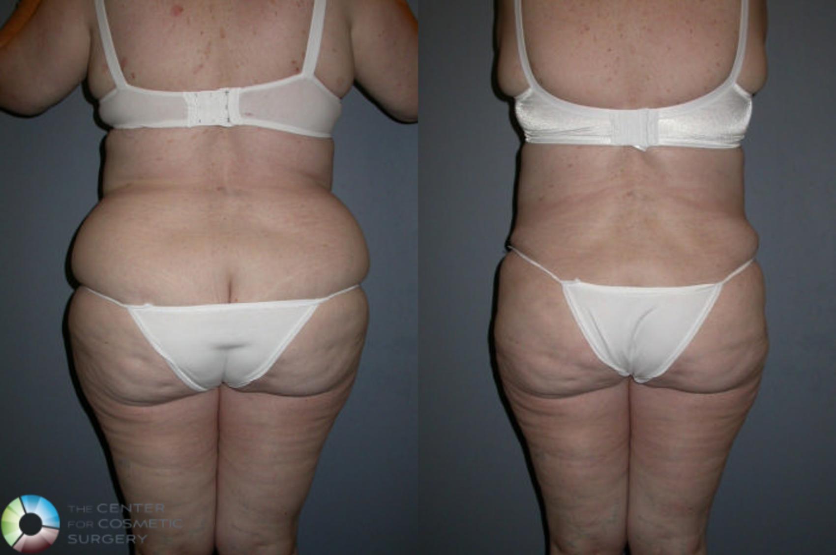 Before & After Liposuction Case 72 View #1 in Denver and Colorado Springs, CO