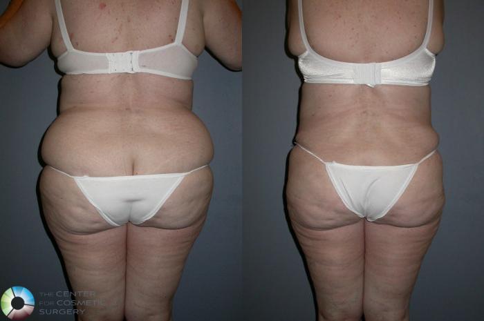 Before & After Liposuction Case 72 View #1 View in Golden, CO