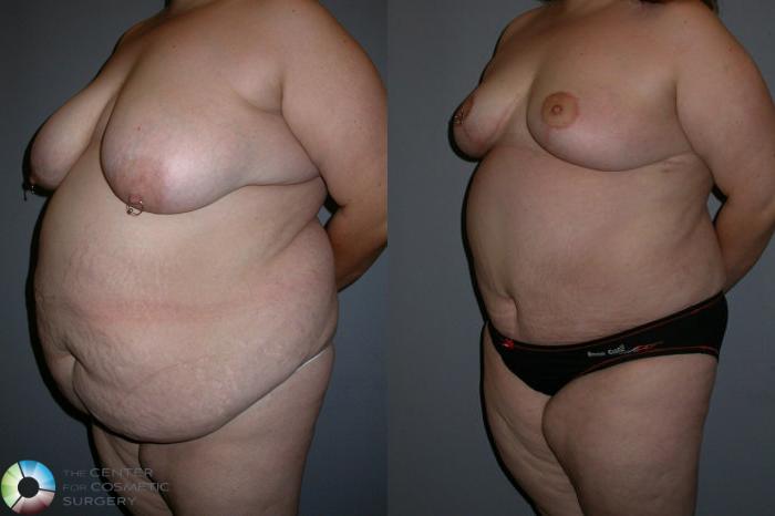 Before & After Liposuction Case 74 View #1 View in Golden, CO