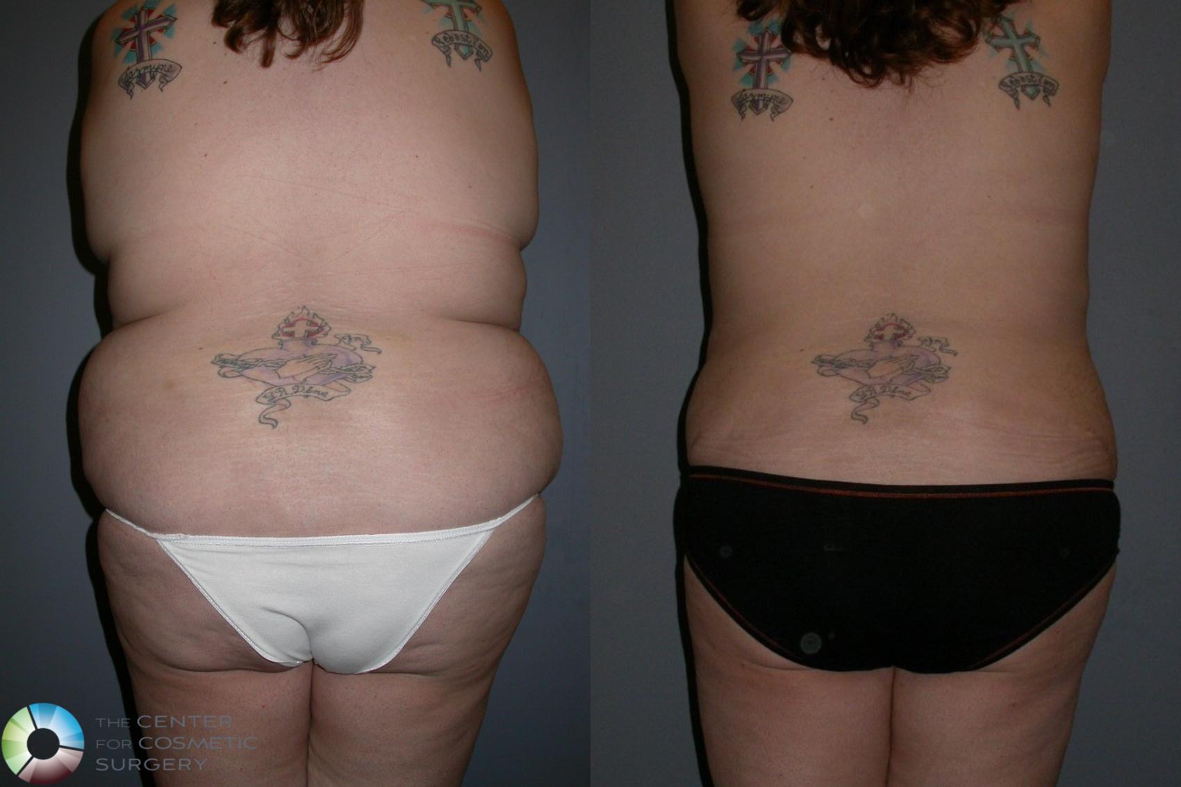 Before & After Liposuction Case 74 View #2 in Denver and Colorado Springs, CO