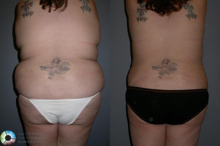 Before & After Power-assisted Liposuction Case 74 View #2 View in Golden, CO