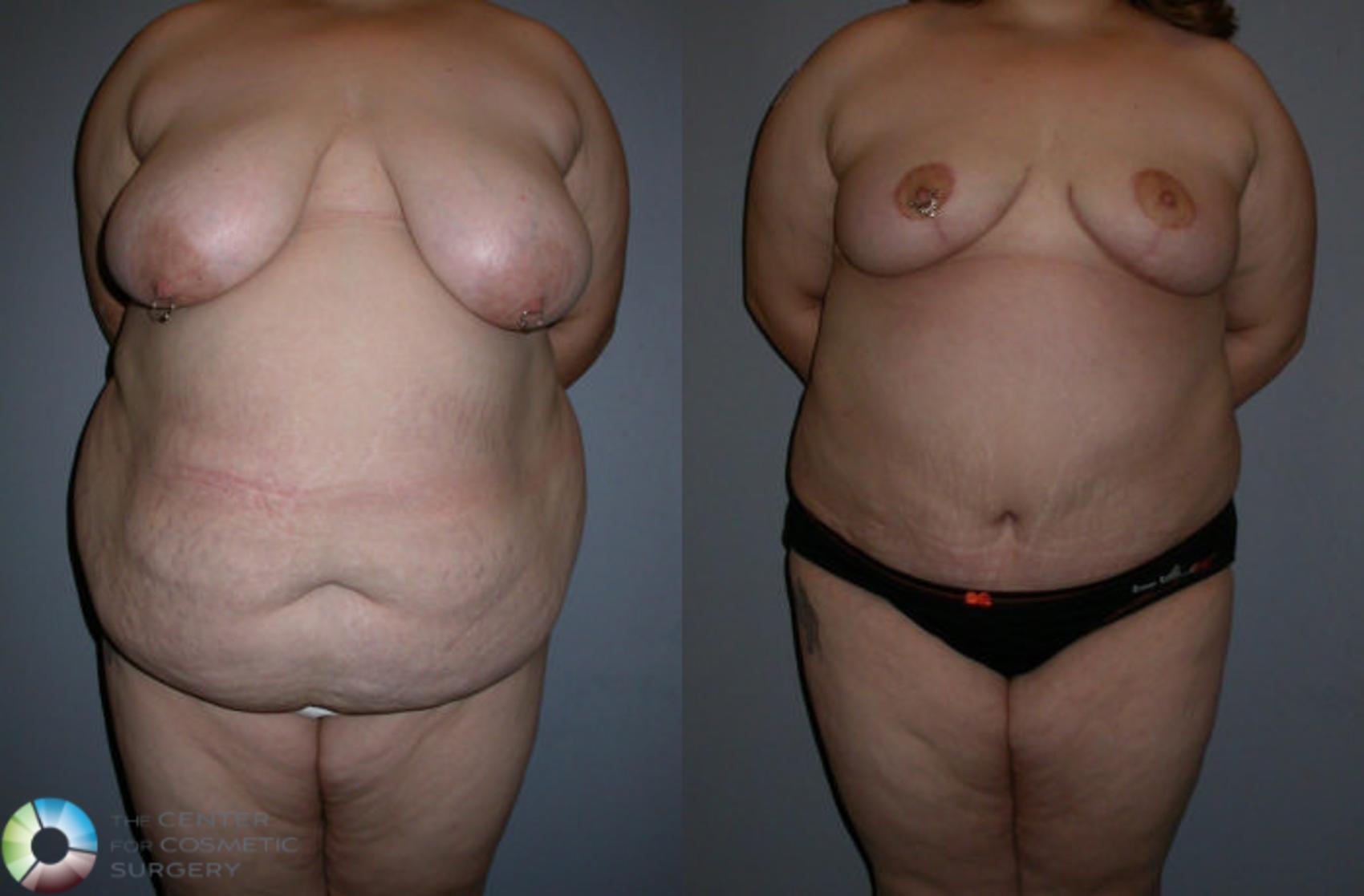 Before & After Liposuction Case 74 View #3 in Denver and Colorado Springs, CO