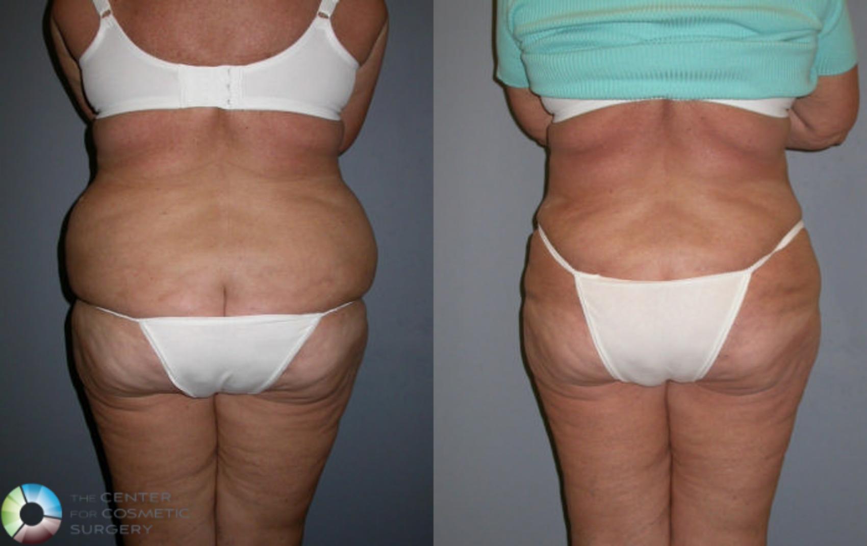 Before & After Liposuction Case 79 View #1 View in Golden, CO