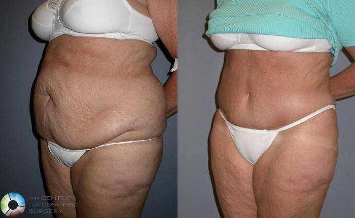 Before & After Liposuction Case 79 View #2 in Denver and Colorado Springs, CO