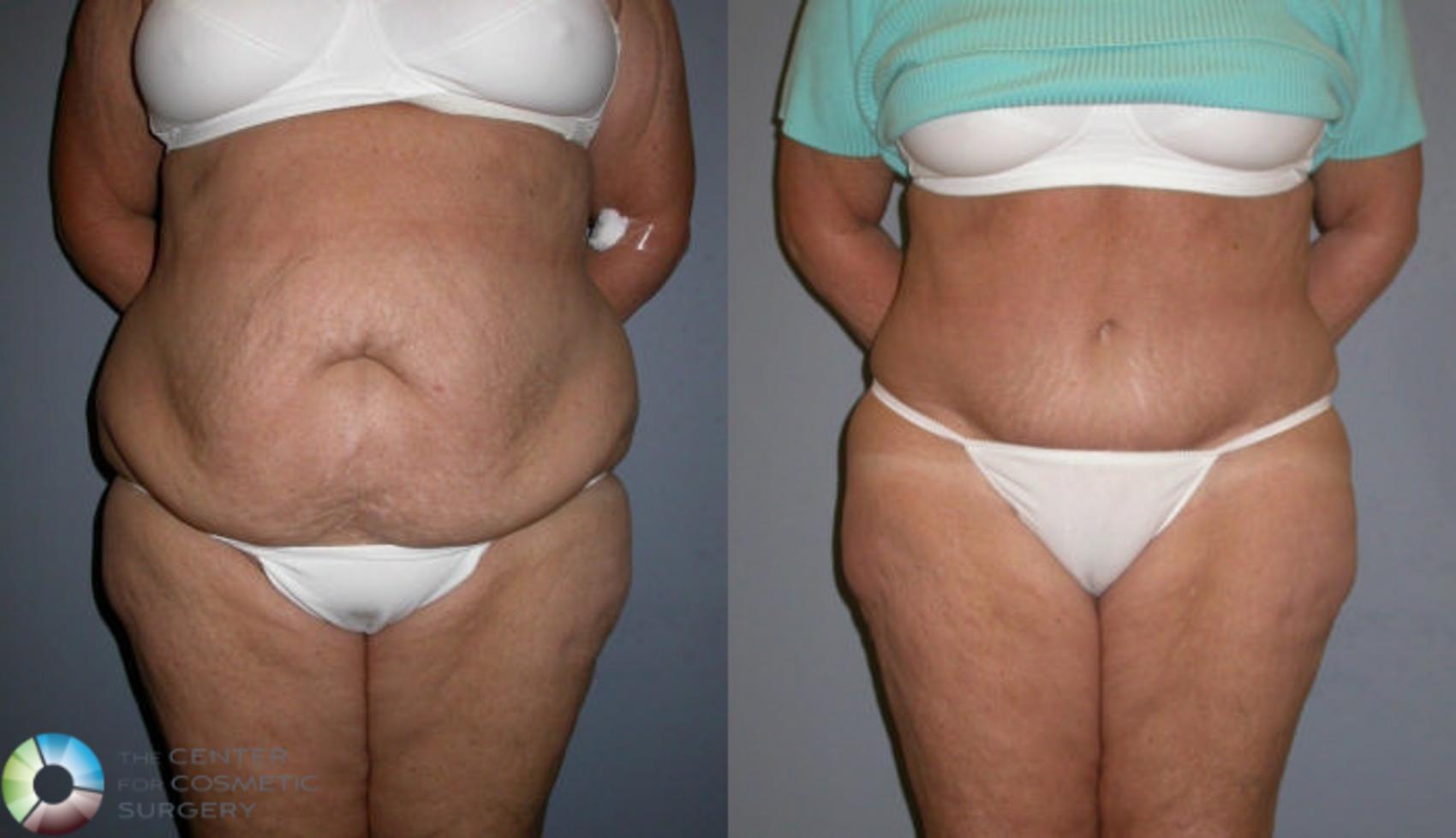 Before & After Liposuction Case 79 View #3 View in Golden, CO