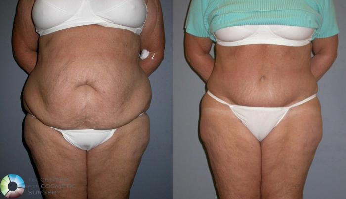 Before & After Power-assisted Liposuction Case 79 View #3 in Denver and Colorado Springs, CO