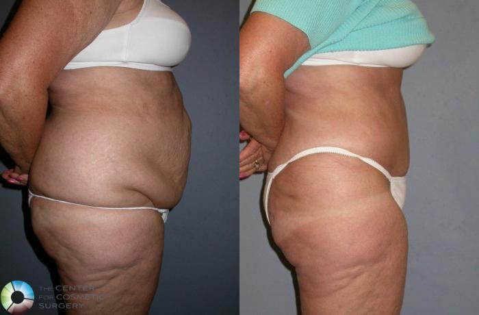 Before & After Power-assisted Liposuction Case 79 View #4 in Denver and Colorado Springs, CO