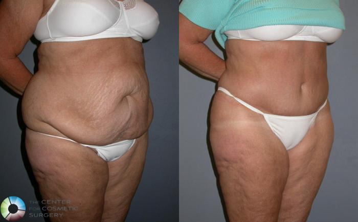 Before & After Power-assisted Liposuction Case 79 View #5 in Denver and Colorado Springs, CO