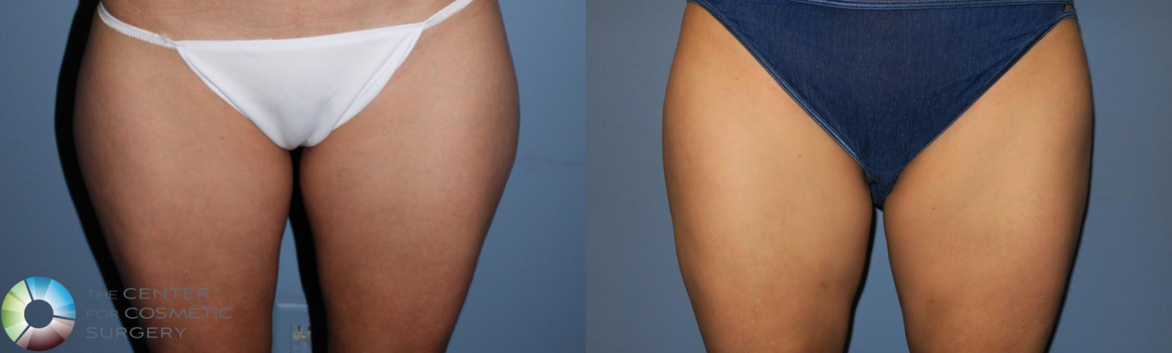 Before & After Liposuction Case 819 View #1 in Denver and Colorado Springs, CO