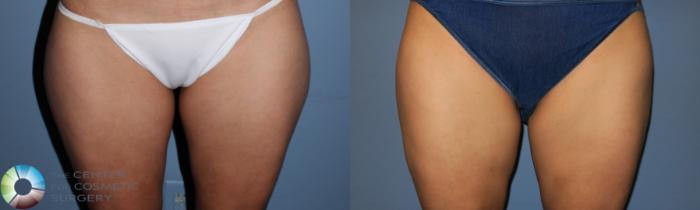 Before & After Liposuction Case 819 View #1 View in Golden, CO
