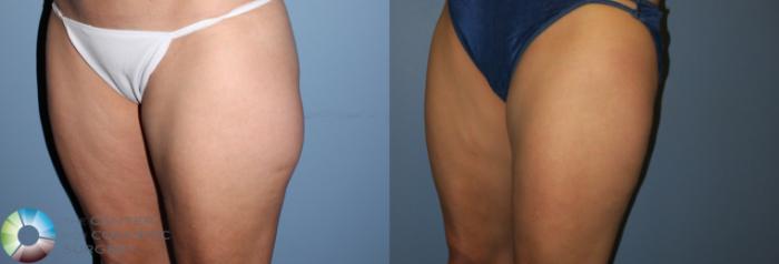 Before & After Liposuction Case 819 View #2 View in Golden, CO