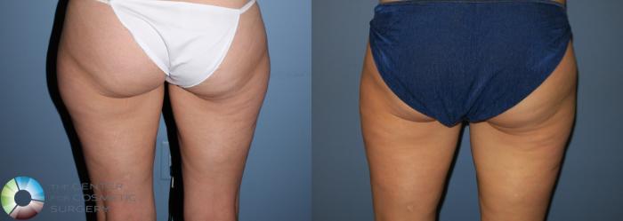 Before & After Liposuction Case 819 View #3 View in Golden, CO