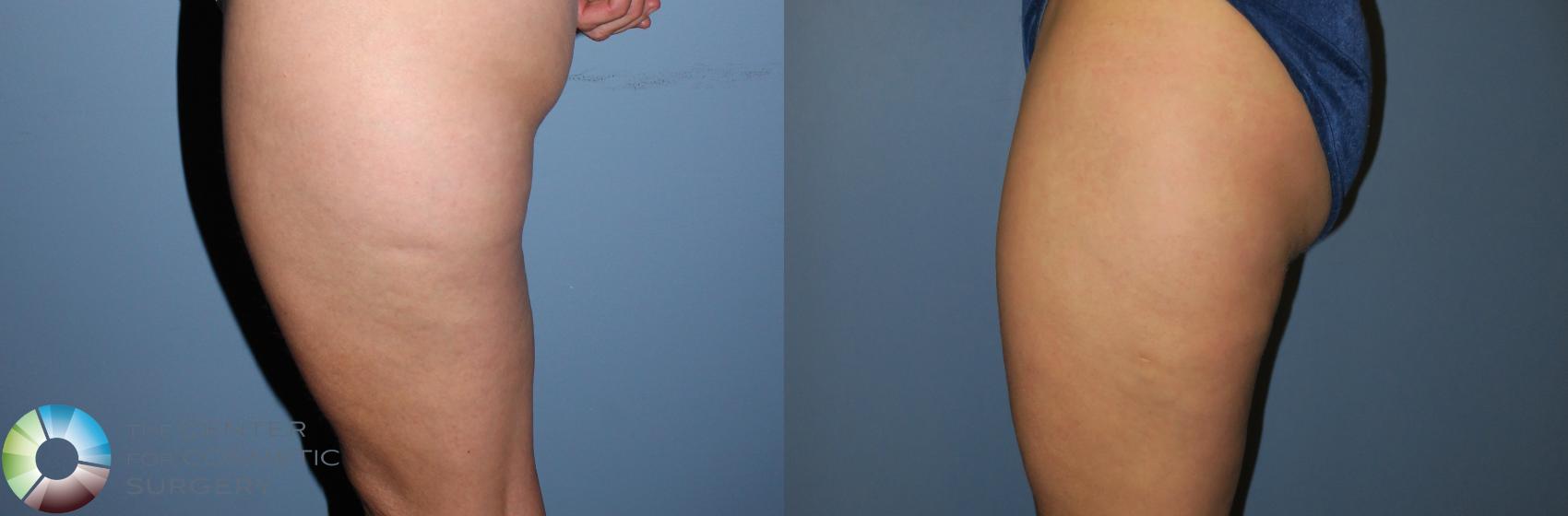 Before & After Liposuction Case 819 View #4 View in Golden, CO