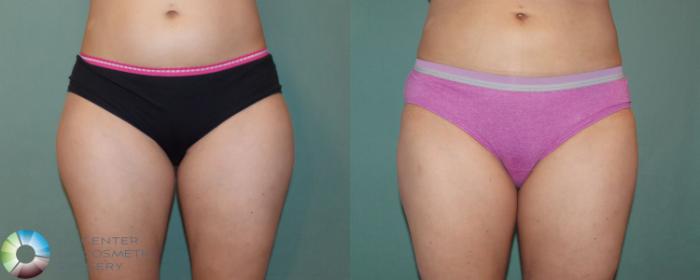 Before & After Liposuction Case 866 View #1 in Denver and Colorado Springs, CO
