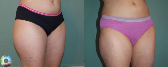 Before & After Liposuction Case 866 View #2 in Denver and Colorado Springs, CO
