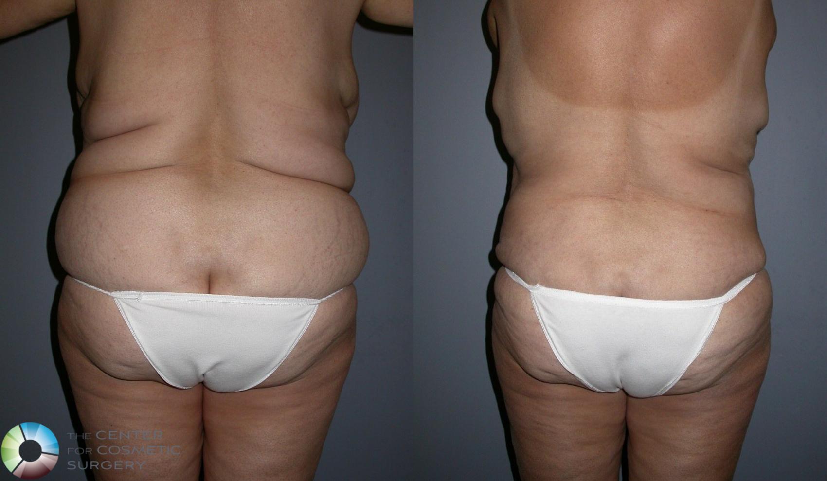 Before & After Liposuction Case 95 View #1 View in Denver & Golden, CO