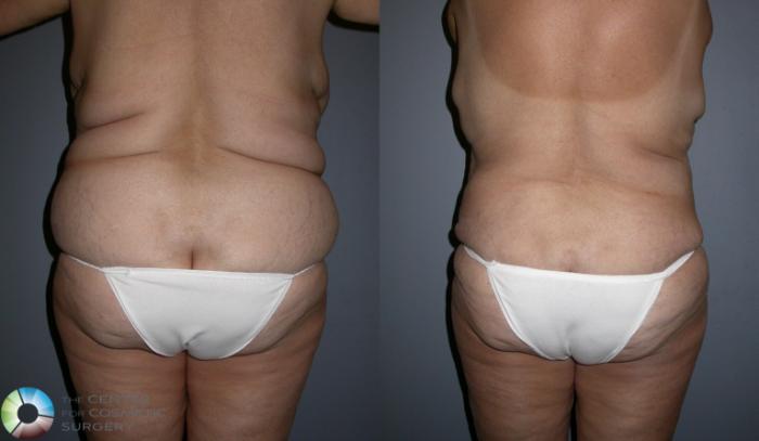 Before & After Power-assisted Liposuction Case 95 View #1 in Denver and Colorado Springs, CO