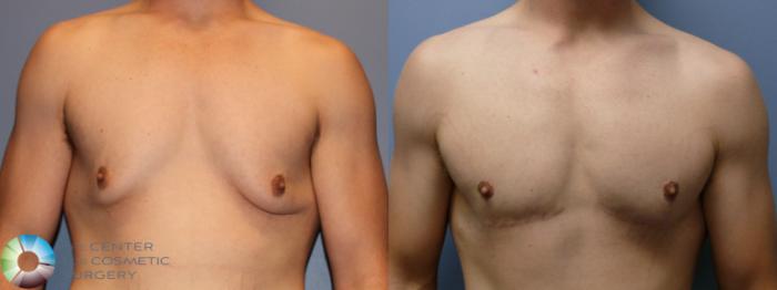 Before & After Male Breast Reduction (Gynecomastia) Case 11665 Front View in Golden, CO