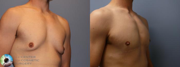 Before & After Male Breast Reduction (Gynecomastia) Case 11665 Right Oblique in Denver and Colorado Springs, CO