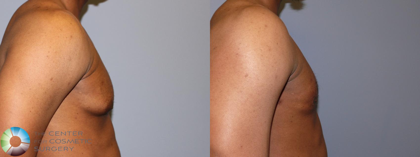 Before & After Male Breast Reduction (Gynecomastia) Case 11666 Right Side in Denver and Colorado Springs, CO