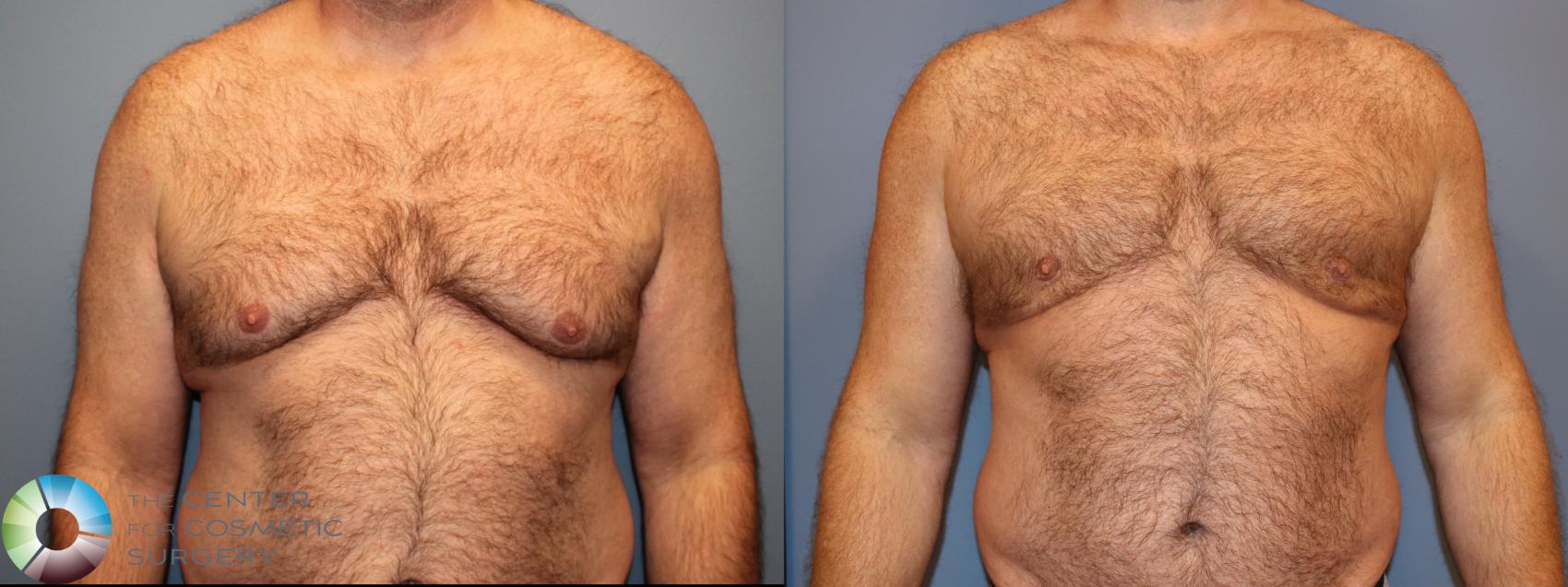 Before & After Male Breast Reduction (Gynecomastia) Case 12012 Front in Denver and Colorado Springs, CO