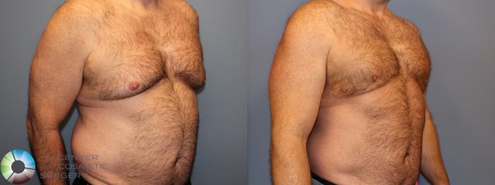 Before & After Male Breast Reduction (Gynecomastia) Case 12012 Right Oblique in Denver and Colorado Springs, CO